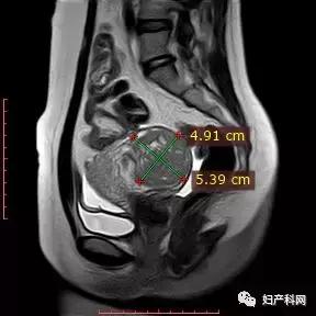 微波消融治疗子宫肌瘤,微无创治疗技术