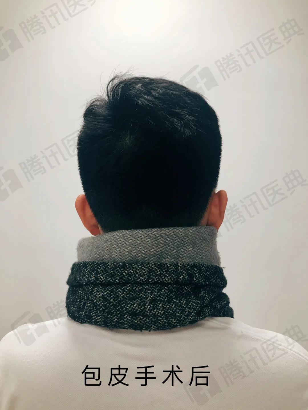 割包皮有割短的情况吗,割包皮有可能割短吗