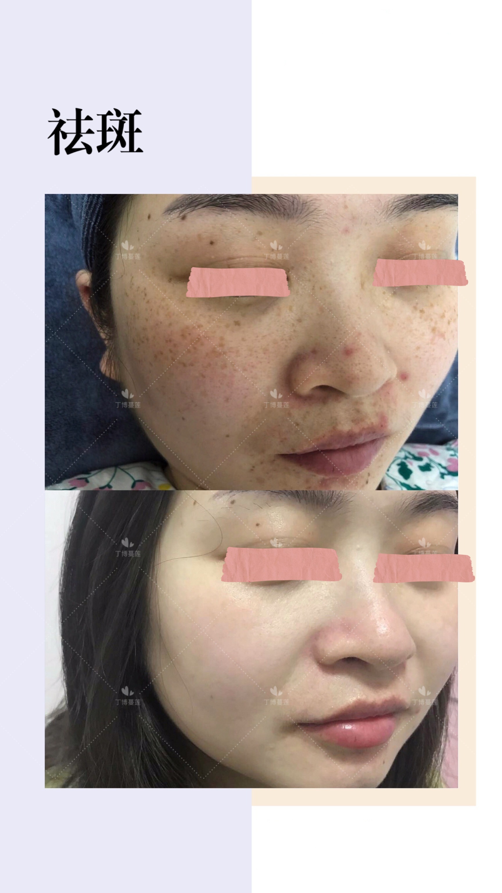 脸上雀斑祛斑最好最安全的方案,根治雀斑祛斑最有效方法