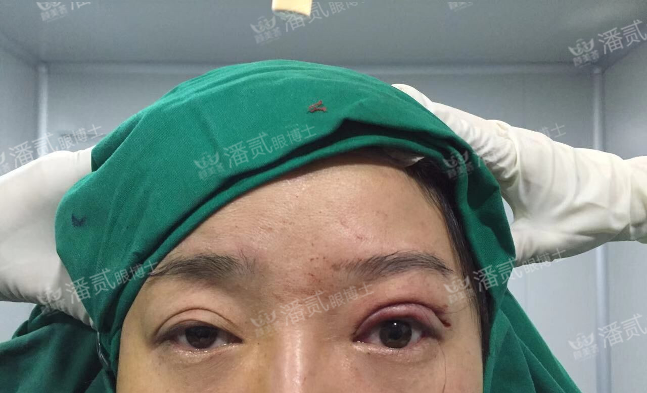 提肌矫正失败的表现眼皮睁不开,做完提肌眼睛前半段下垂