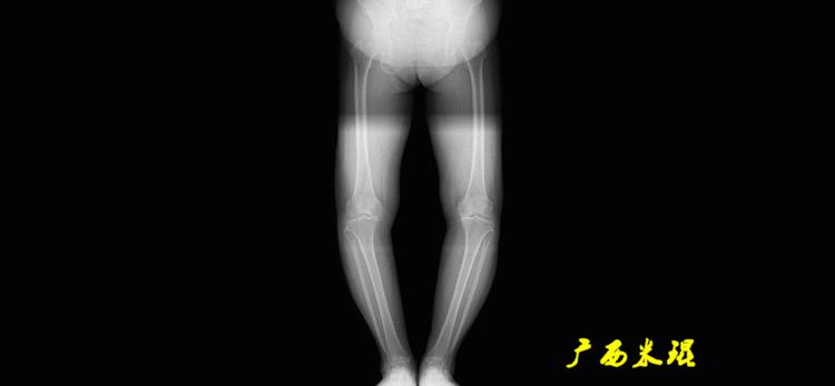 广西骨科医生米琨最新信息,米琨广西骨科什么水平