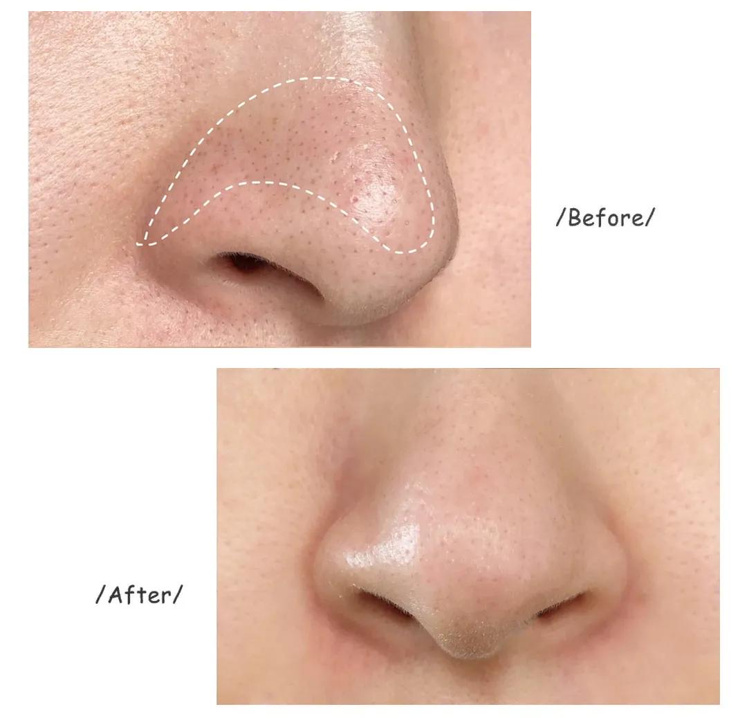 油性肌肤应该怎么样去除黑头,油腻皮肤毛孔粗大黑头多怎么清理