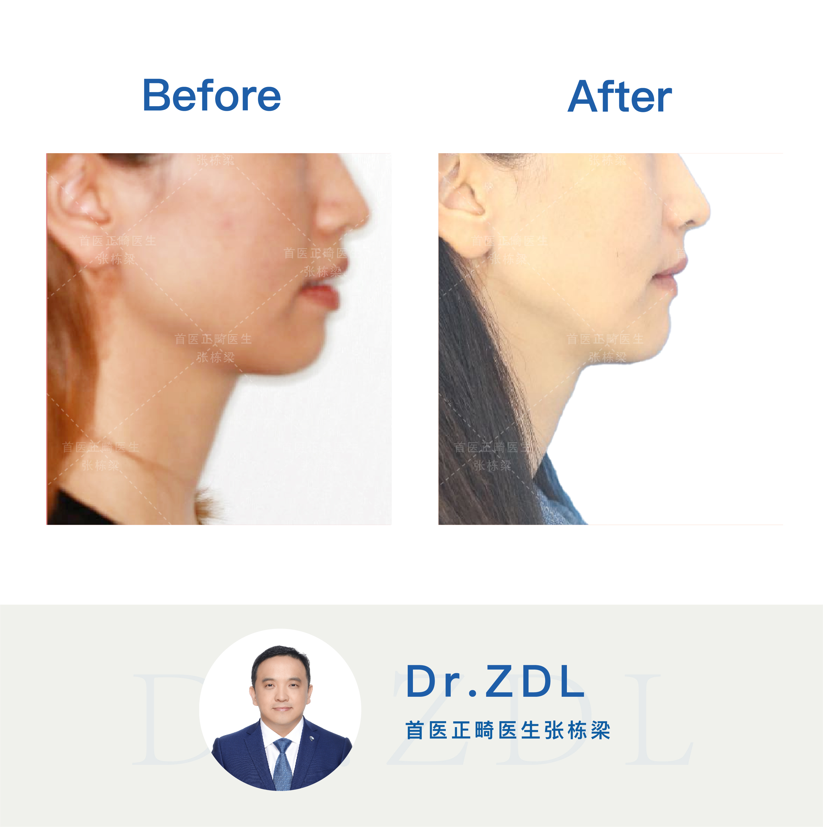 嘴突不做牙齿矫正后果,嘴突没有龅牙可以修复吗