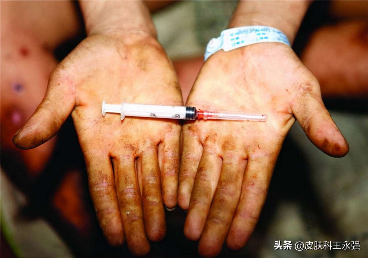 艾滋病患者，前期会有哪些表现？怎样正确的预防，医生一步步教你