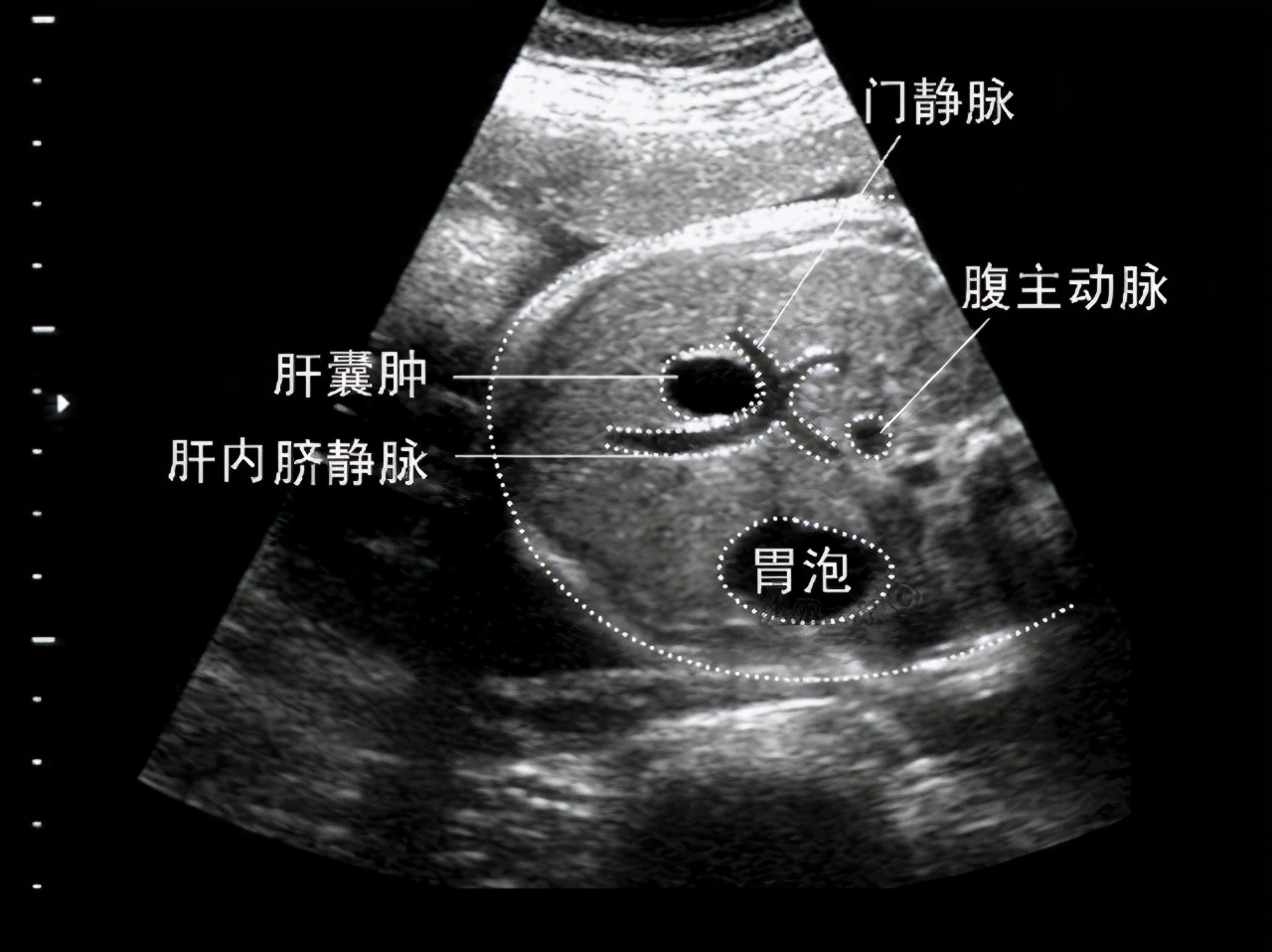 b超查出肝囊肿会不会是肿瘤,b超检查出肝结节会误诊吗