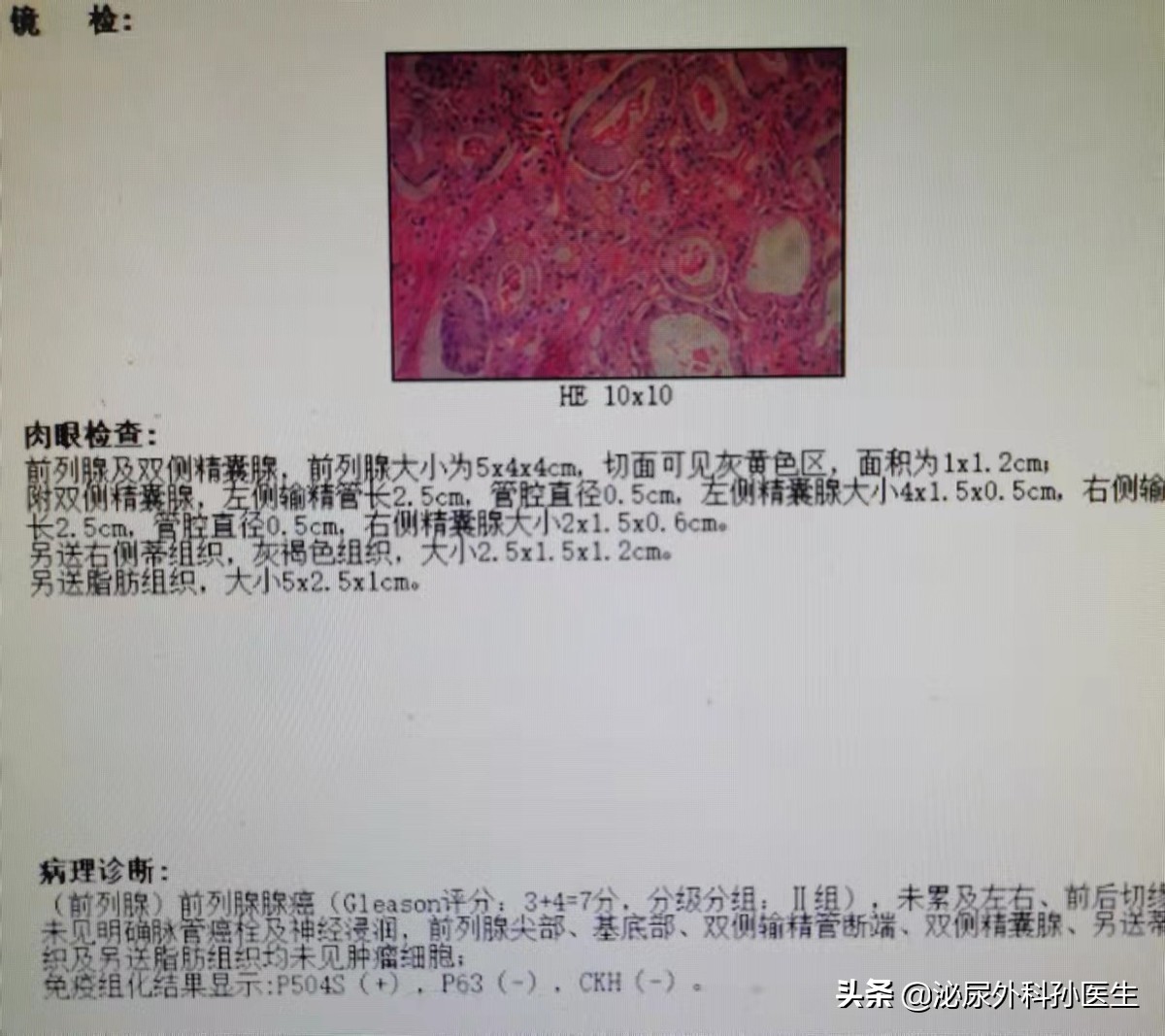 前列腺不典型小腺泡增生是癌症吗,前列腺增生血尿会是癌症吗