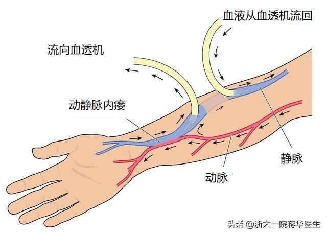 肾移植后透析的瘘要不要闭掉,肾移植术后瘘自然闭了怎么办