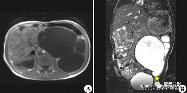 18种泌尿生殖系统常见疾病MR诊断总结