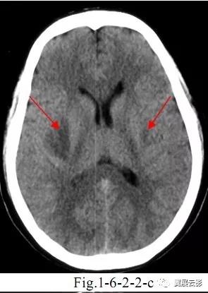 脑部脓肿怎么治疗,多发性脑脓肿能自愈吗