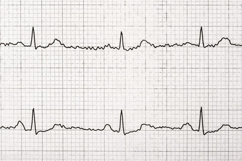 桥本甲减服药治疗效果仍然不佳，心率达到110次/分，真无法可治？