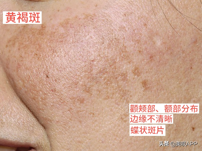 脸上有斑怎么祛斑最快最有效,脸上长斑点用什么药才能祛斑