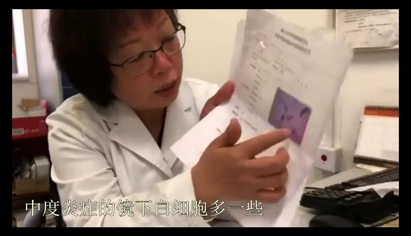 宫颈癌筛查tct轻度炎症严重吗,宫颈癌tct检查有炎症hpv16阳性