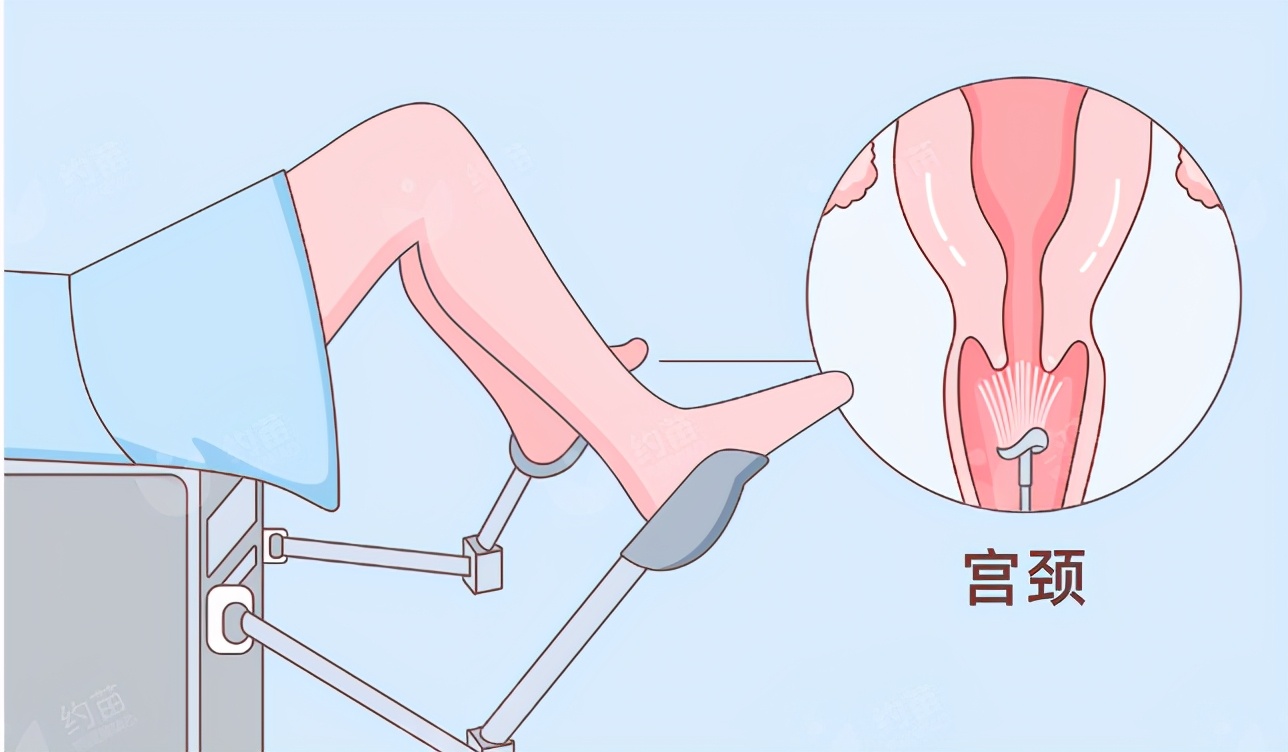 宫颈癌筛查e6e7阳性是什么意思,宫颈癌筛查有几个报告