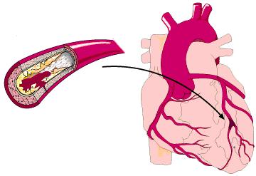 高血压病人不用药后果,高血压不用吃药也变正常