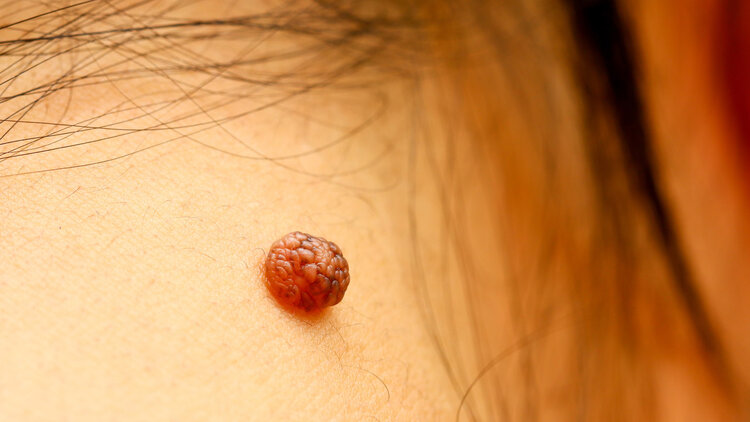 这几个部位长痣癌症信号,痣长在这地方竟等于癌症前兆