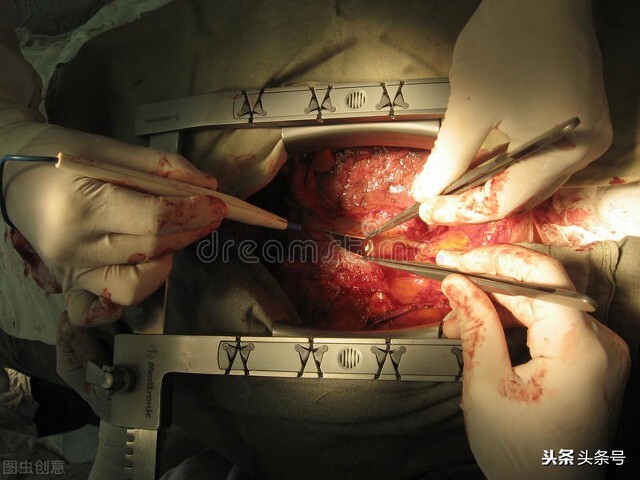 急性心肌梗死血管全部堵塞怎么办,心血管堵塞60%严重吗