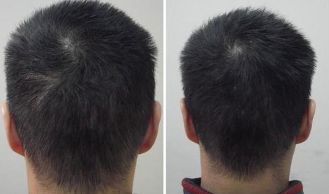 碧莲盛植发后期养护费用高不高,做完植发医院要求去做养护有用吗