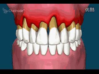 牙龈萎缩牙齿松动中医有什么方法,牙齿松动怎么办教你一招恢复