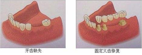 上门牙缺失3颗做牙桥修复方案,缺牙缝隙大能做固定桥修复吗
