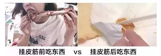 戴一个牙套会掉吗,戴个牙套对嘴唇有变化吗