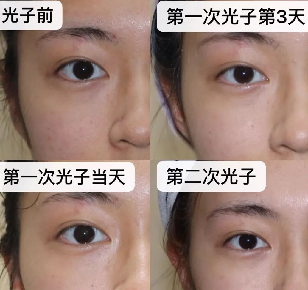 假闭口成因,假闭口真闭口怎么区别