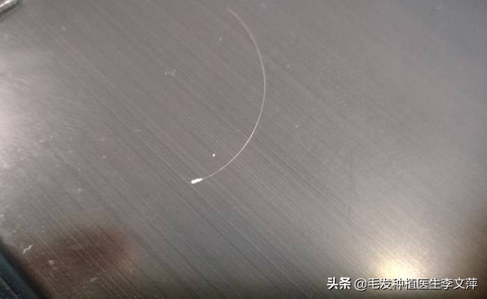 掉发发根带白色颗粒是毛囊吗,毛囊松动头发一碰就掉发根有白点