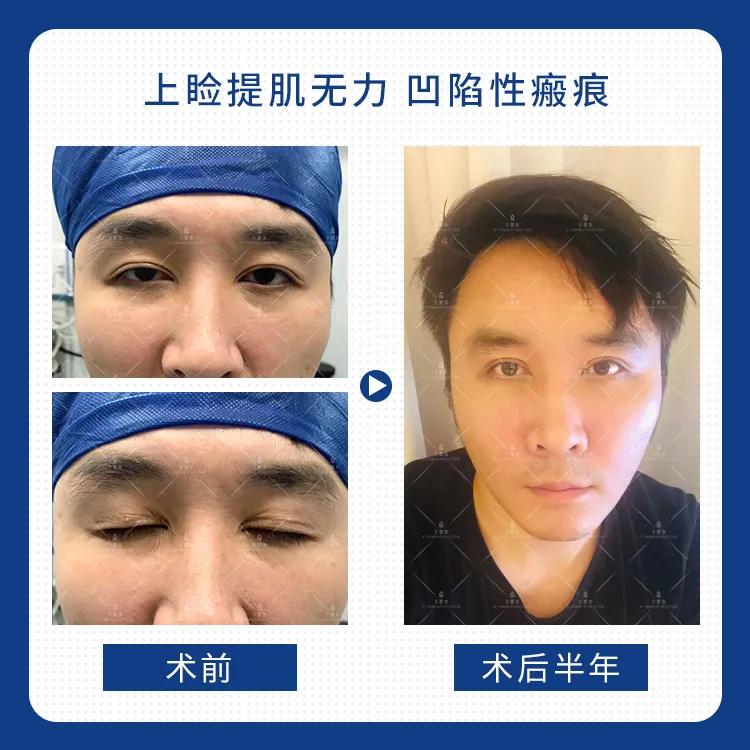 于景浩修复双眼皮图片,于景浩做双眼皮修复怎样