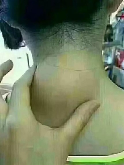 推拿怎么治疗富贵包,富贵包怎么推拿消除最有效