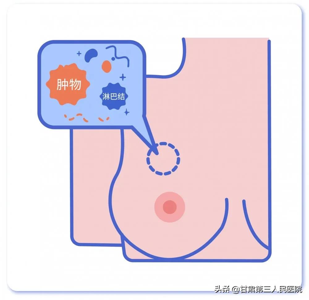 提到“乳房活检”，医生or患者在想些什么？