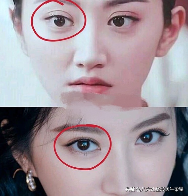 平行式双眼皮变成普通窄双眼皮了,悲伤蛙双眼皮图片