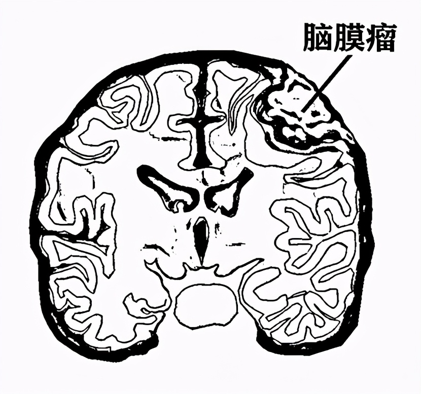 脑膜瘤术后一年后复发怎么办,脑膜瘤复发后不能手术该怎样治疗