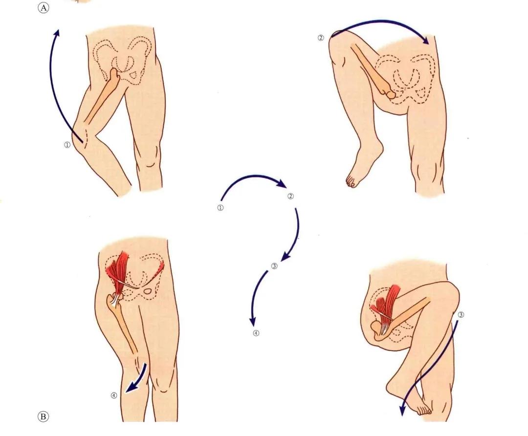 髋关节脱位闭合复位方法,髋关节脱位复位治疗过程