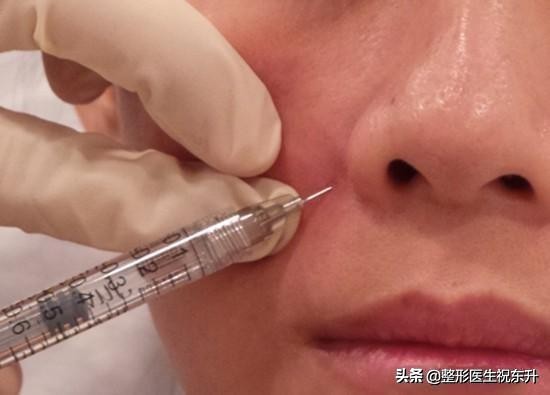 玻尿酸填充法令纹怎么有凹凸不平,玻尿酸填充法令纹后两边不对称
