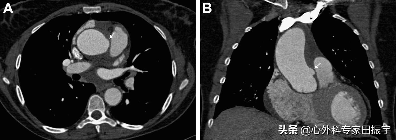 主动脉血肿危险期,高危脑动脉瘤破裂出血