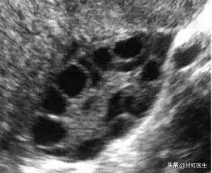 27岁月经乱了FSH两次升高，我卵巢早衰了吗？