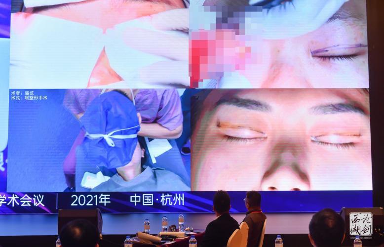 潘二博士双眼皮修复失败案例,潘二医生双眼皮