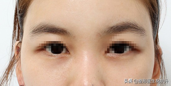 “祛眼袋”这件事,您试过几种妙招?说实话“还是手术靠谱”