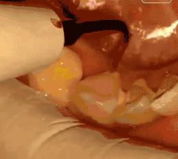 牙龈萎缩出血洗牙能治吗,洗牙后吃硬物仍牙龈出血