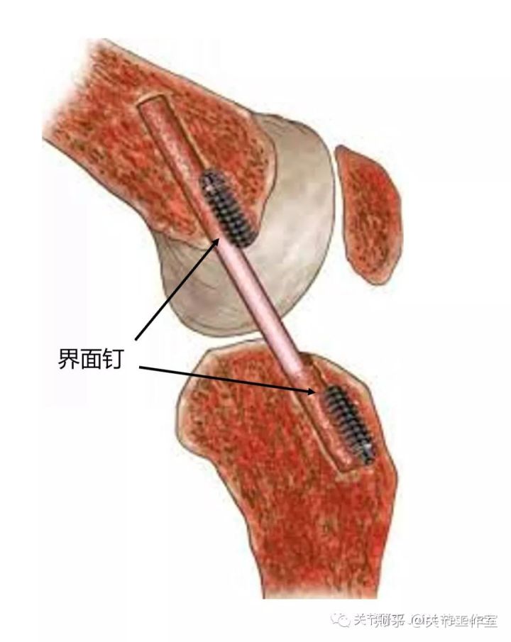 前交叉韧带断裂为什么没评上伤残,前交叉韧带断裂有什么症状