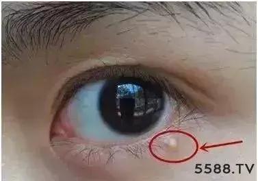 长脂肪粒是不是皮肤屏障受损,长脂肪粒不是眼霜的问题吧