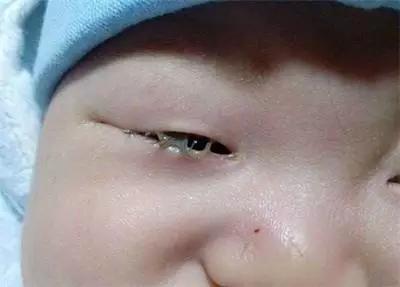 宝宝眼屎多并非都是上火惹的祸!这几种情况需要就医