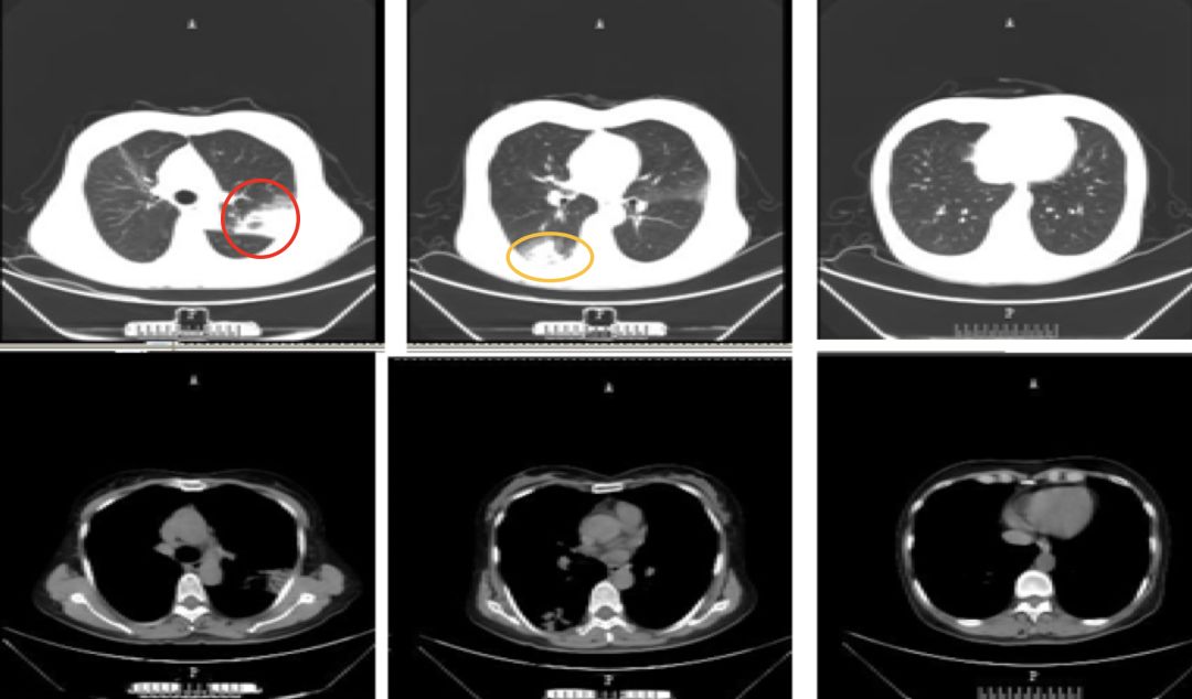 抗感染治疗后效果欠佳，感染非感染？TBLB和肺穿刺病理有哪些提示