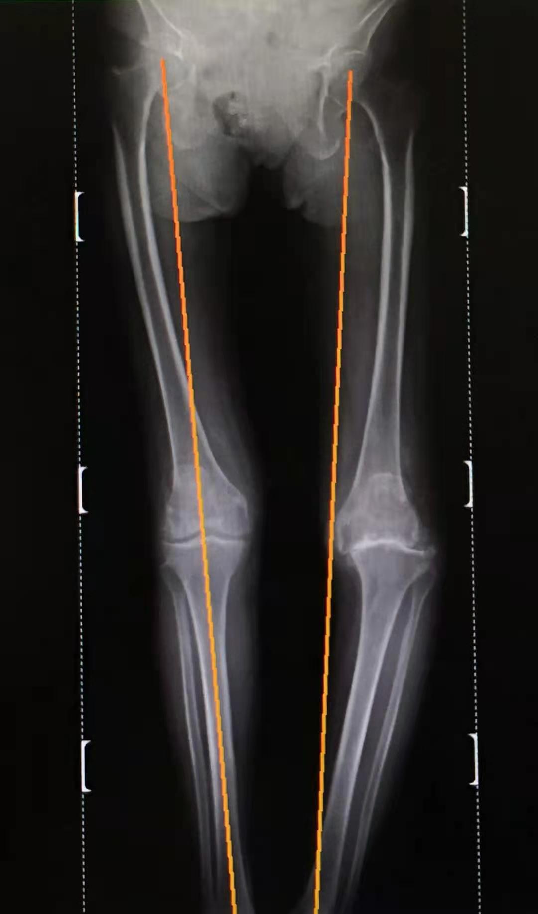 双膝功能障碍患者通过TKA手术重获行走功能