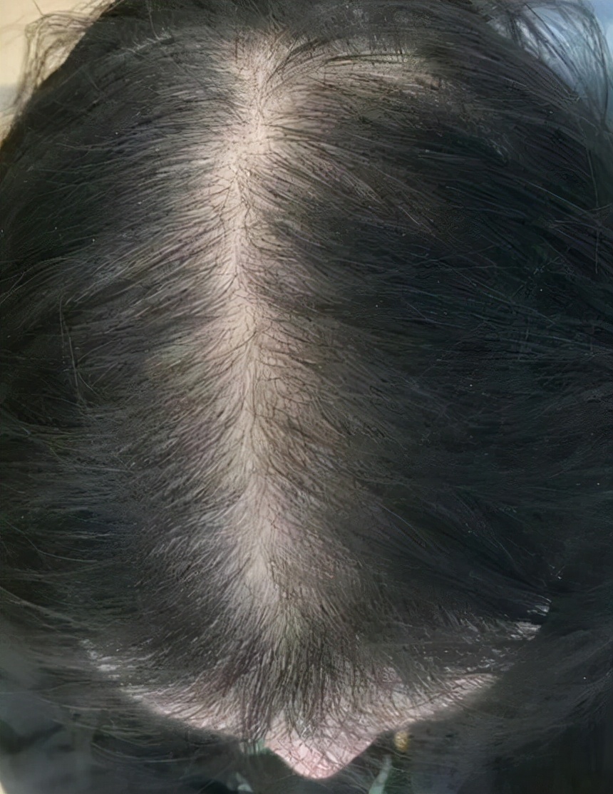 头秃怎么拯救女性,女性雄秃是什么意思