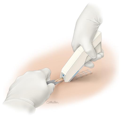 外伤缝合人工好还是订书机缝合好,骨科手术为什么用缝合钉