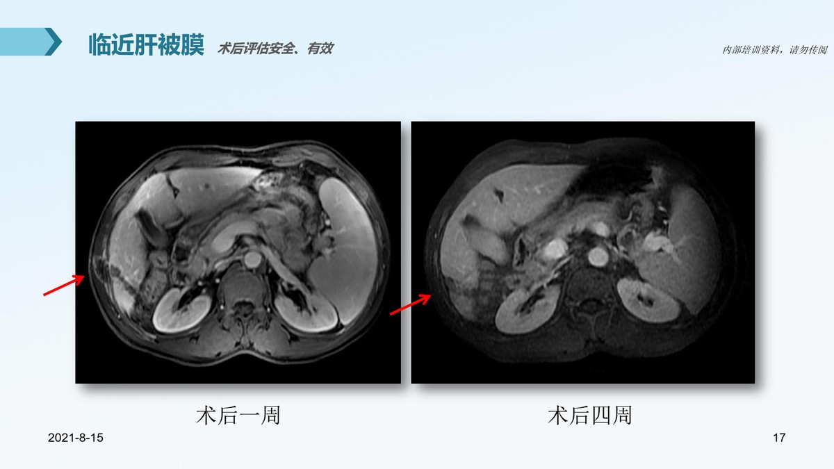 氩氦刀治疗肿瘤的医院,氩氦刀治疗肿瘤范围多大