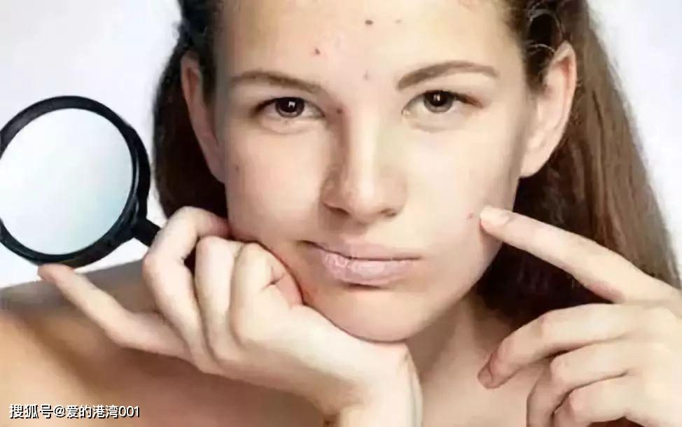 祛痘印的方法怎么可以快速祛痘印,如何快速去痘印简单有效方法介绍