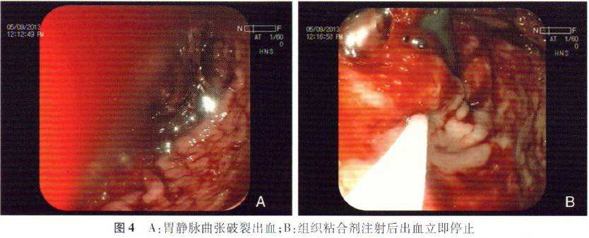 胃镜有治疗作用吗,胃镜有什么用处