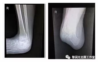 伊里扎洛夫外固定架治疗足部畸形,足部畸形矫正的技巧