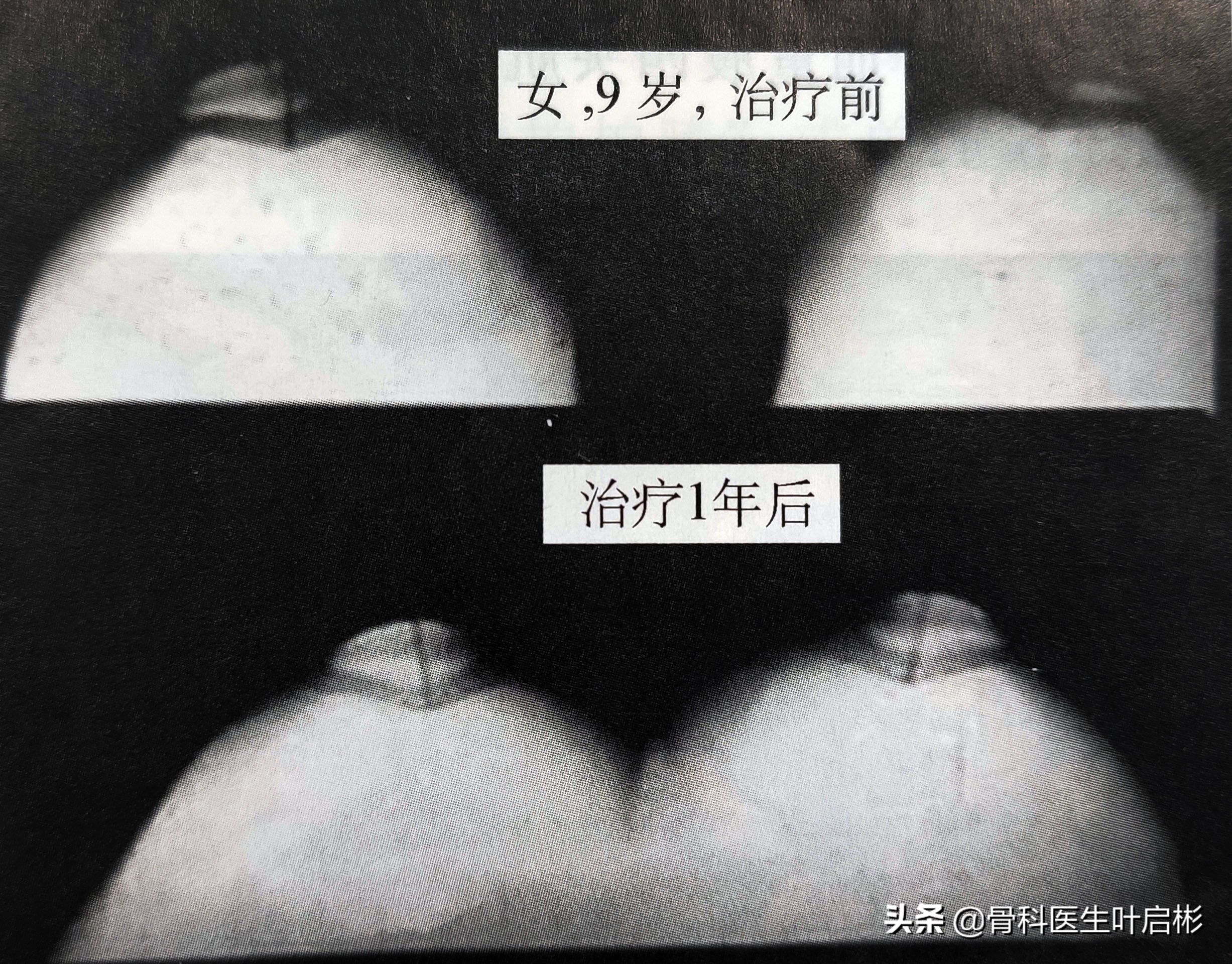 髌骨软化症髌骨矫正,髌骨软化半脱位怎么治疗才能治愈